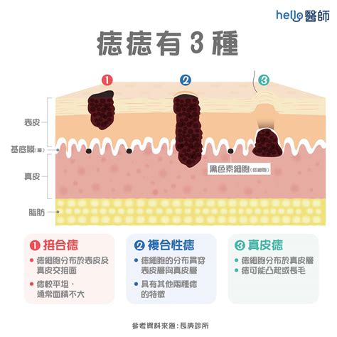 為什麼身上會有痣|痣變大、痣多或長毛會變皮膚癌？認識痣的形成與原因